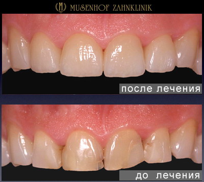 Примеры протезирования зубов в Германии