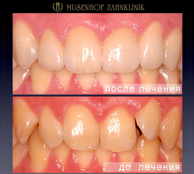 Пример протезирования зубов в центре Музенхоф (Германия)